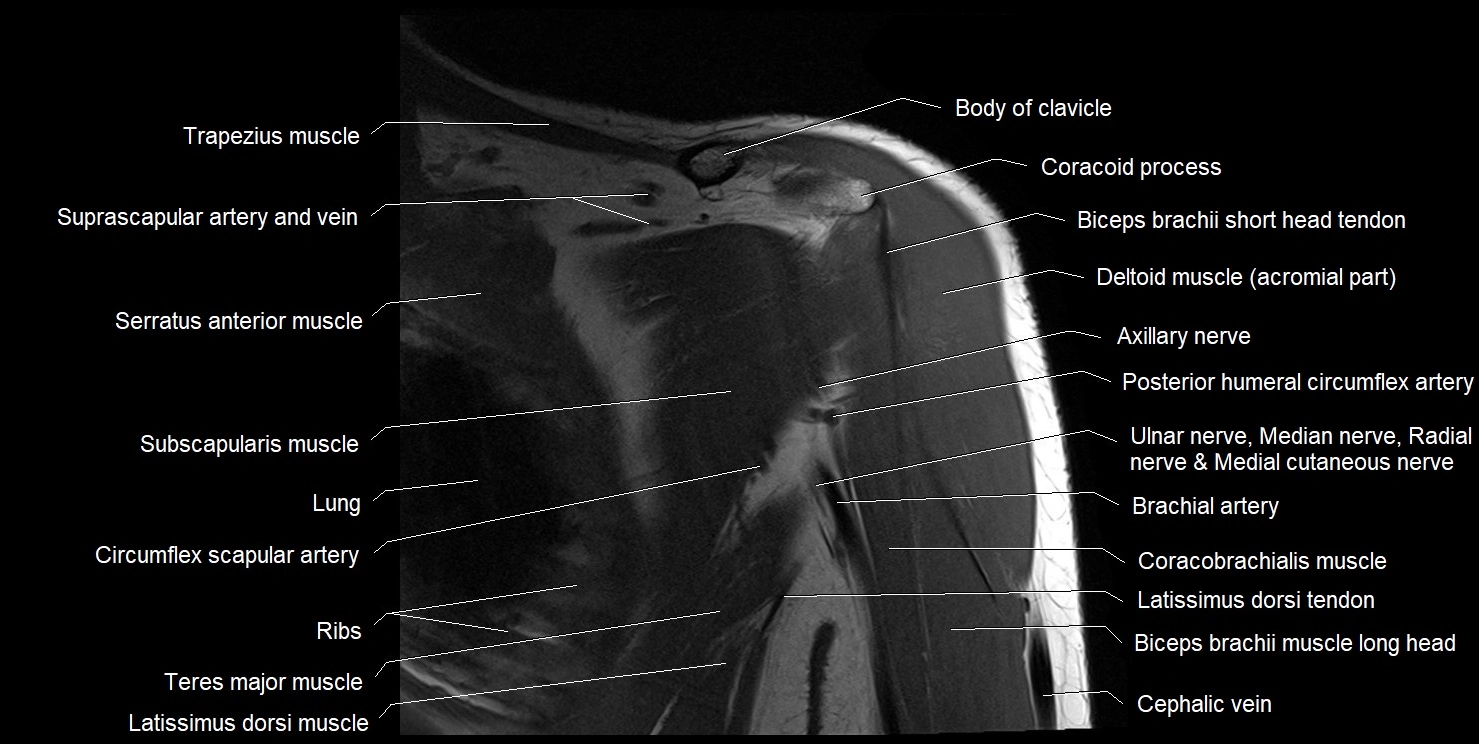 mri shoulder coronal cross sectional anatomy image 5.webp